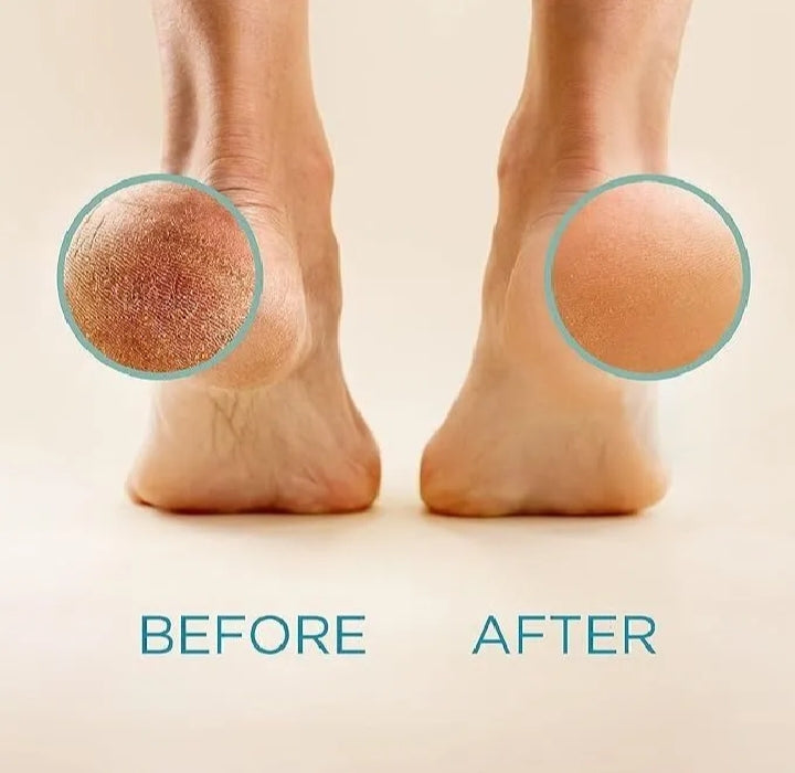 Electric Foot Callus Remover – Smooth Heels Pro